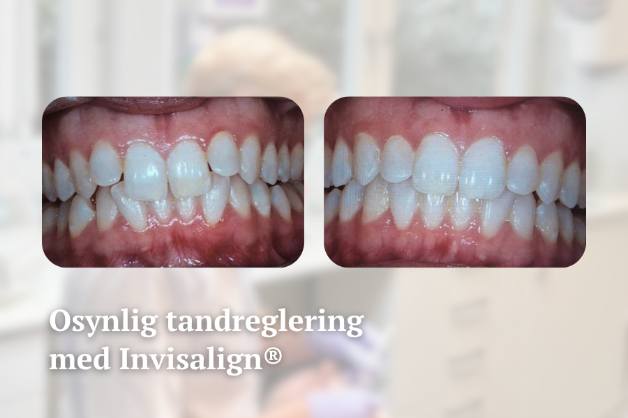 Startsida Invisalign osynlig tandreglering