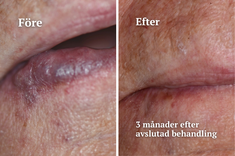 Startsida Hemangiom behandlad med laser